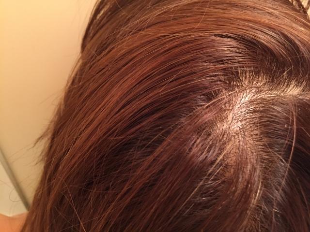 女性の頭皮が荒れる原因とは 改善策や抜け毛との関係性も解説 スカルプd ボーテ公式サイト アンファー